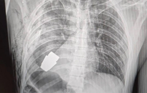 "Приємний шок": лікарі витягли гранату, що не розірвалася, з тіла бійця ЗСУ