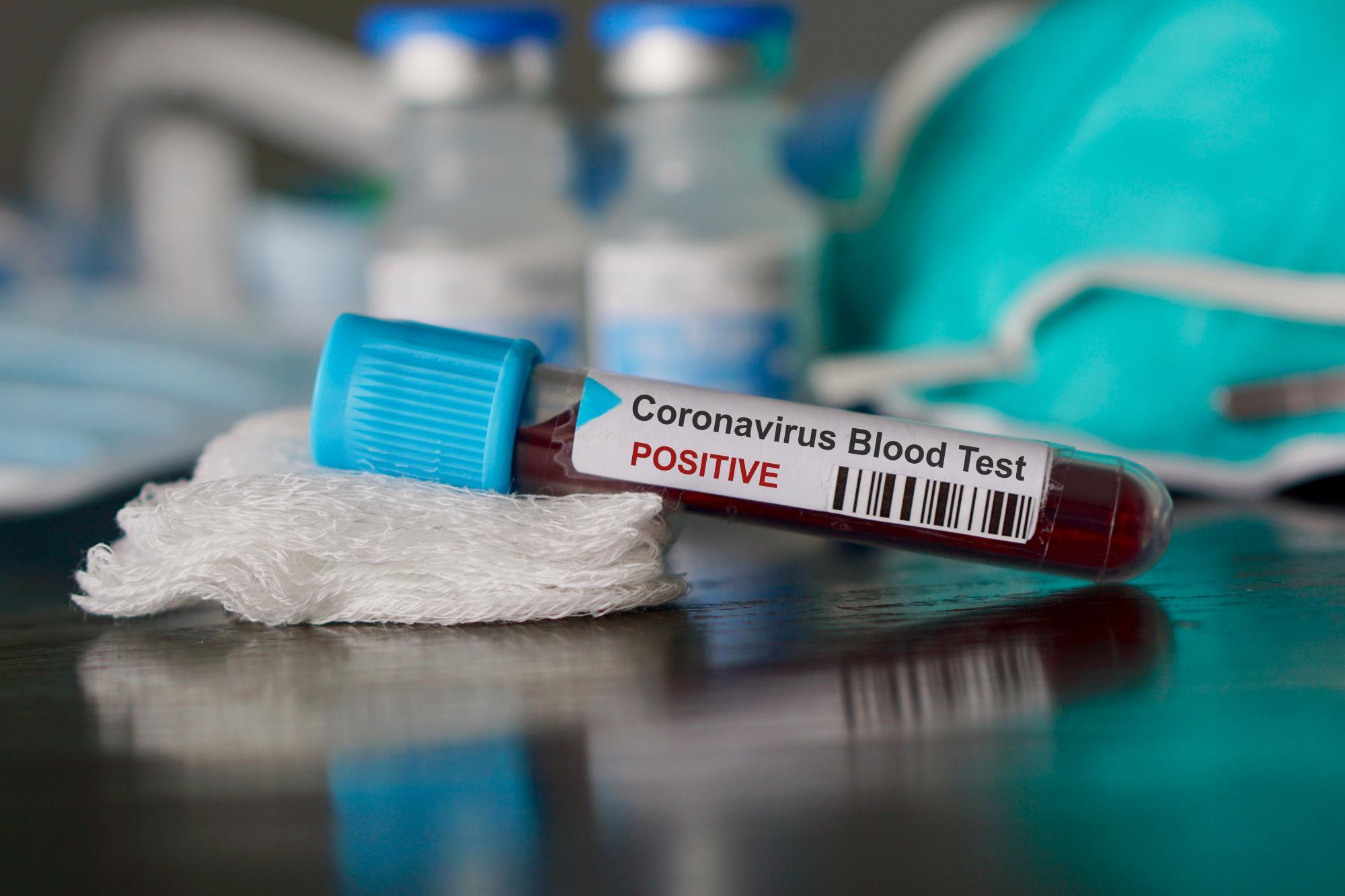 В Україні зафіксували вже п'ять лабораторно підтверджених випадків коронавірусу