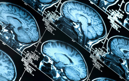 Тесты на чувствительность к боли помогут в диагностике болезни Альцгеймера