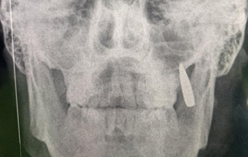 Дізнався після рентгену: у бійця ЗСУ застрягла куля в зубах
