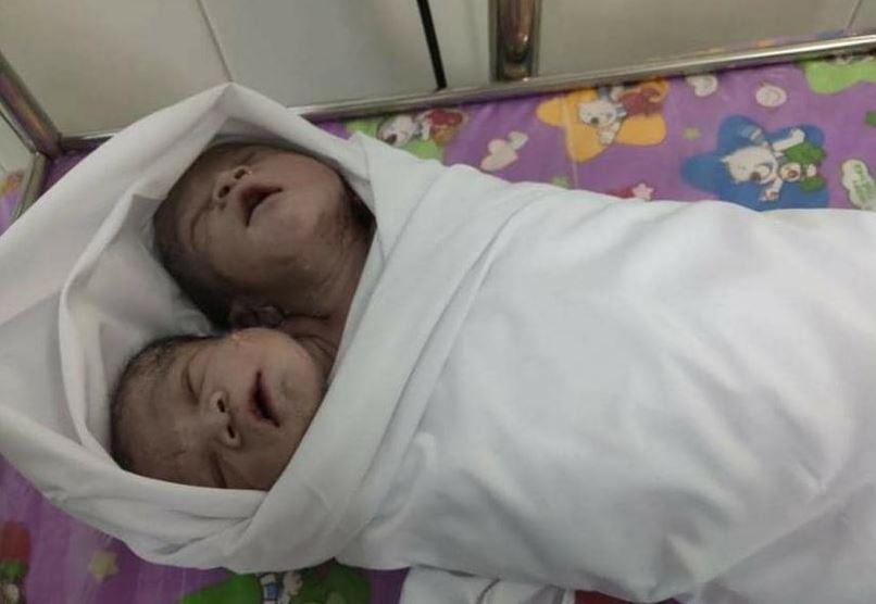 У М'янмі народилася здорова двоголова дитина. ФОТО