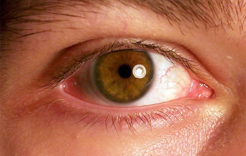 На Тернопільщині пацієнти втратили зір після ін'єкції, декому довелося видаляти очі. ВІДЕО