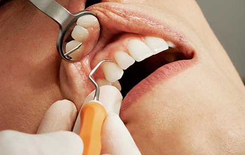 Американка подала до суду на стоматолога за спробу вилікувати 28 зубів за п'ять годин