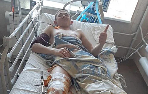 На Львовщине медики семь часов пришивали парню отрезанную бензопилой ногу