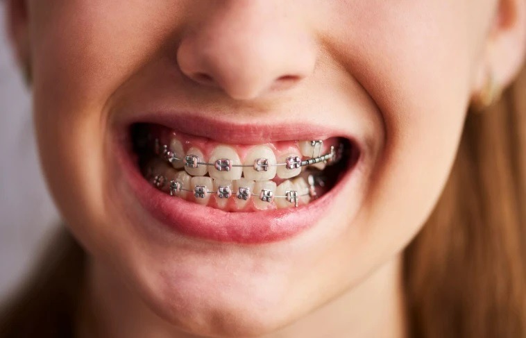 Де встановити брекети у Львові: 5 приватних клінік з ортодонтичним напрямом