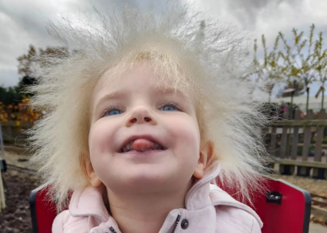 У трирічної дівчинки з Великої Британії діагностували синдром нерозчесаного волосся: таких людей лише 100 на весь світ. ФОТО