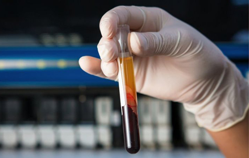 Розроблено аналіз крові, який виявляє 50 типів раку