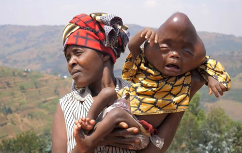 В Руанде женщина родила ребенка с головой в форме груши