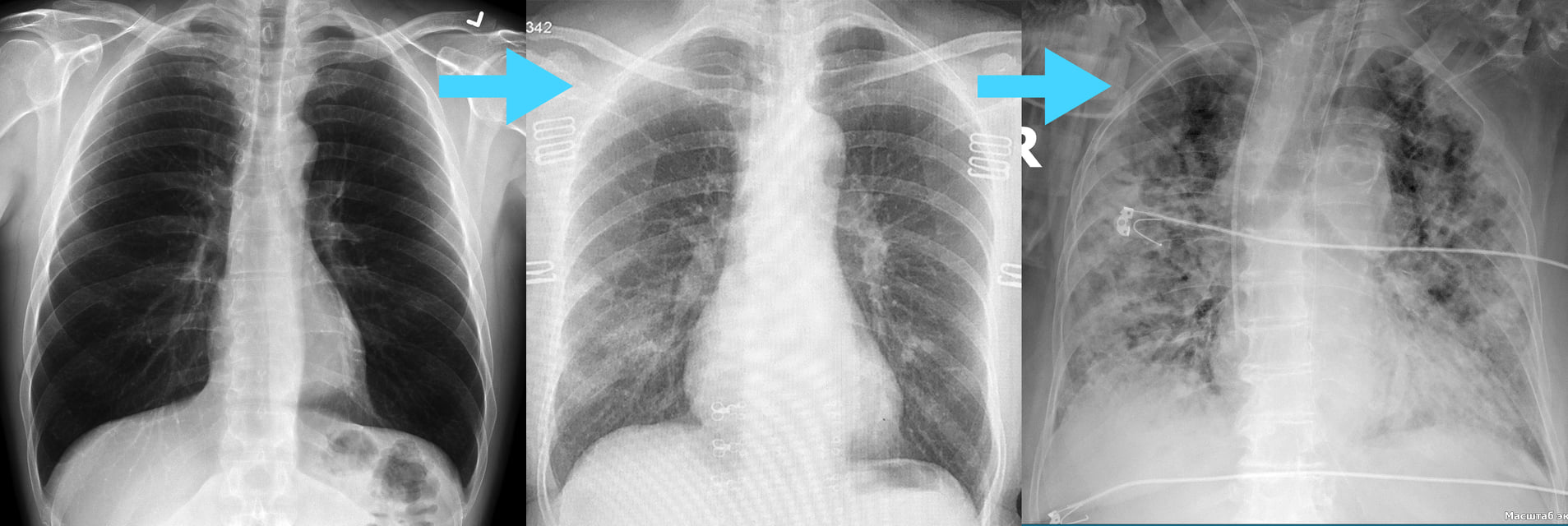 Лікар-рентгенолог: Що воно таке ця ковідна пневмонія і як вона розвивається? 