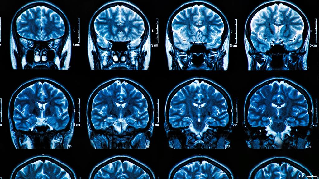 COVID-19 может поражать мозг сильнее болезни Альцгеймера – исследование