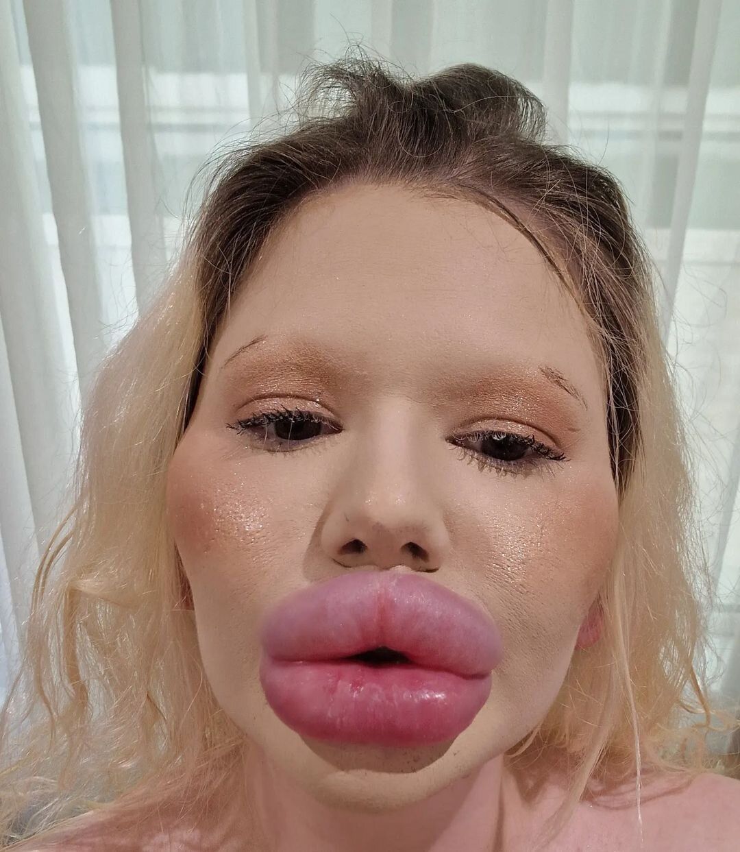 Жінка з найбільшими губами у світі зробила нові ін'єкції: який вона має вигляд