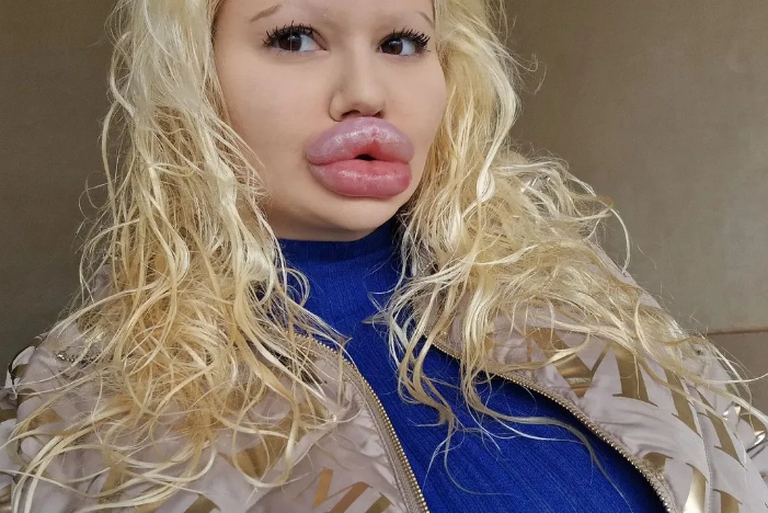 Жінка з найбільшими губами в світі зробила 6 "уколів краси" за один день, хоча лікарі попереджували, що її тіло почне гнити. ФОТО