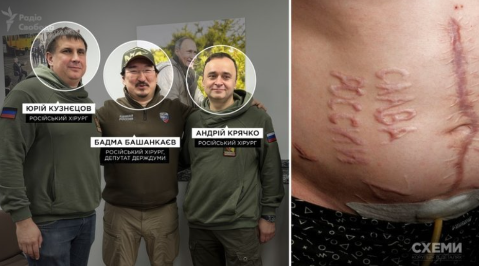 ЗМІ встановили російських хірургів, які випалили "Слава России" на тілі українського полоненого