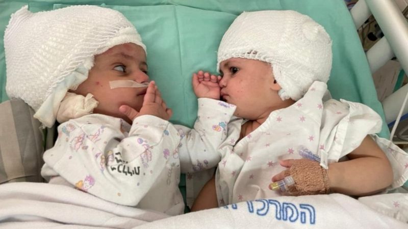Вперше побачилися: в Ізраїлі розділили з'єднаних головами близнючок