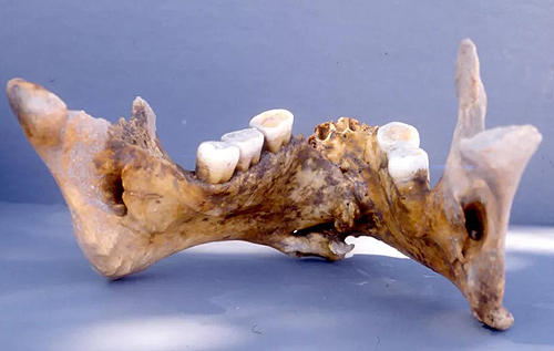 Ученые обнаружили, что византийские хирурги в XIV веке успешно лечили переломы челюсти с помощью золота
